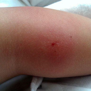 closeup of inflamed bug bit on arm